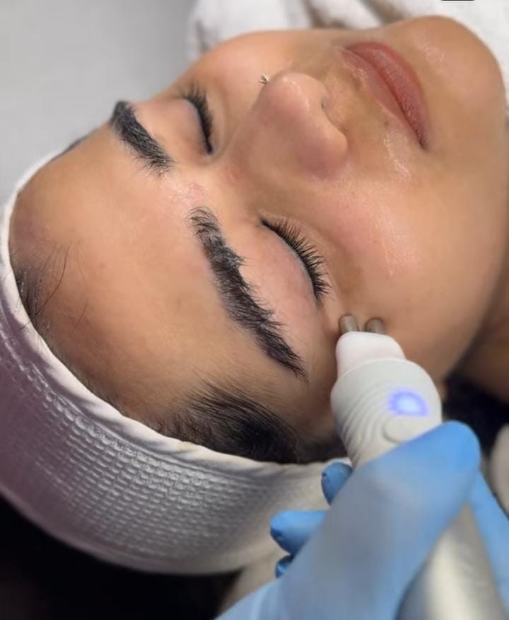 Radio Frequency Skin Tightening