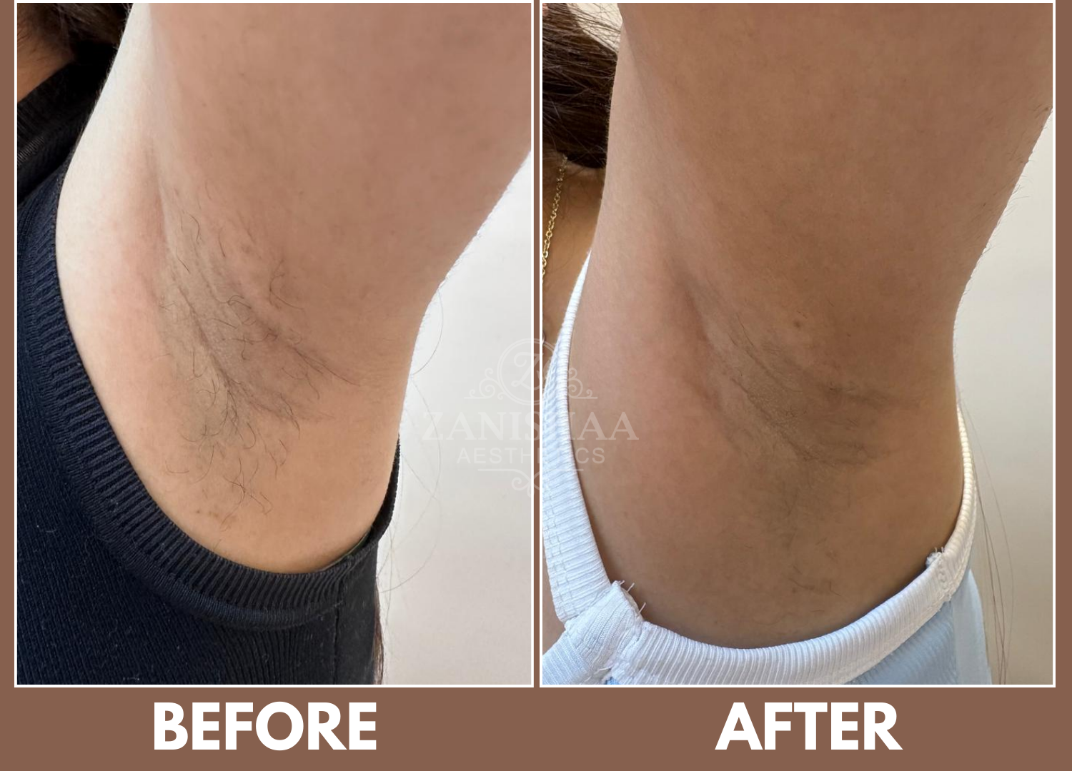 Laser Hair Removal Result 1