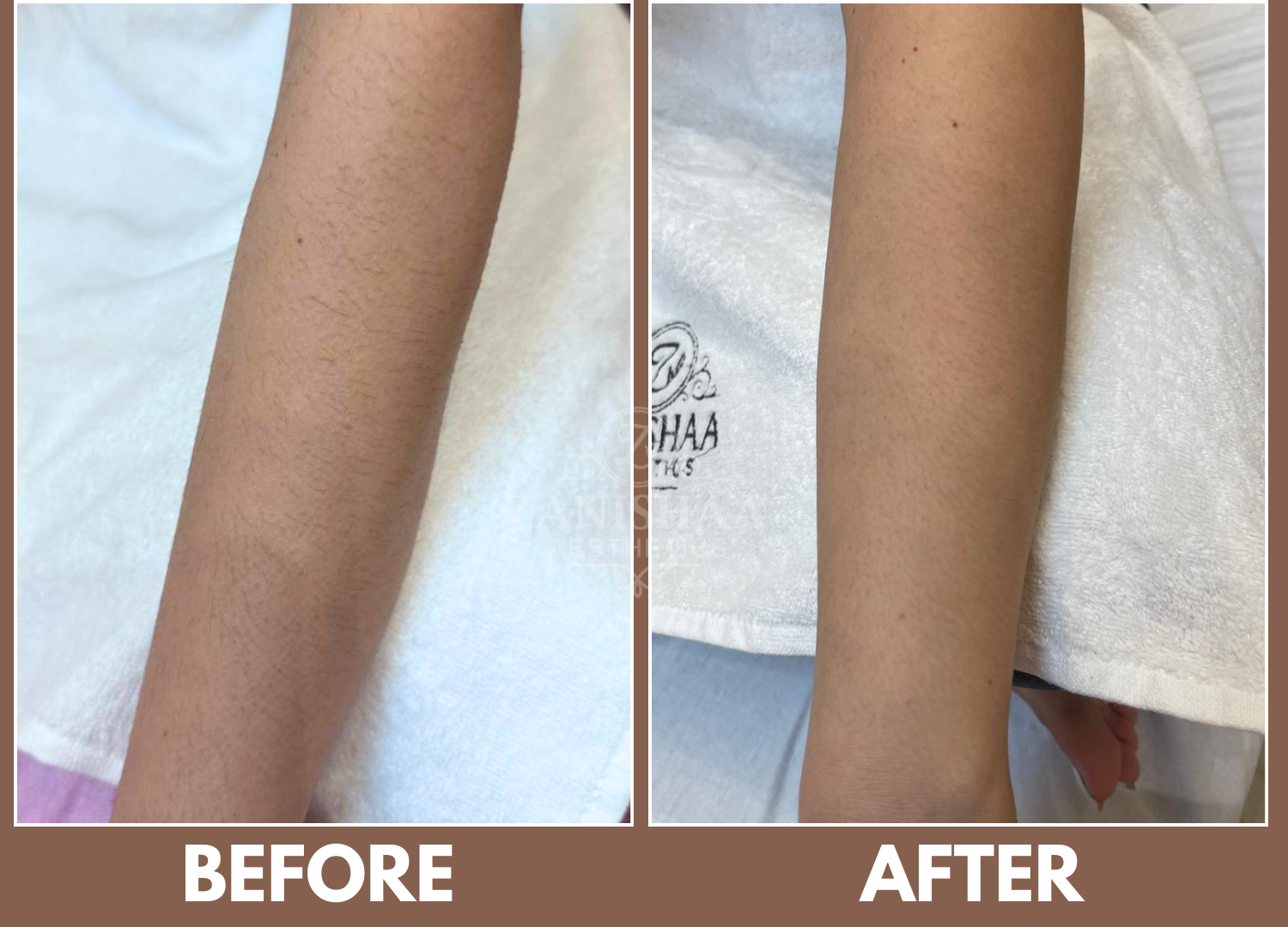 Laser Hair Removal Result 2